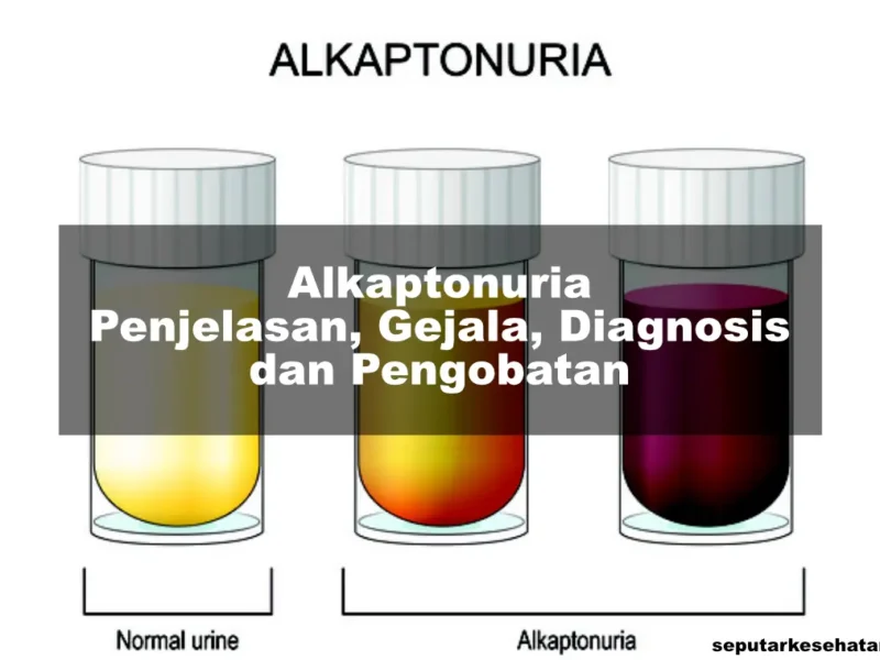 Alkaptonuria- Penjelasan, Gejala, Diagnosis dan Pengobatan