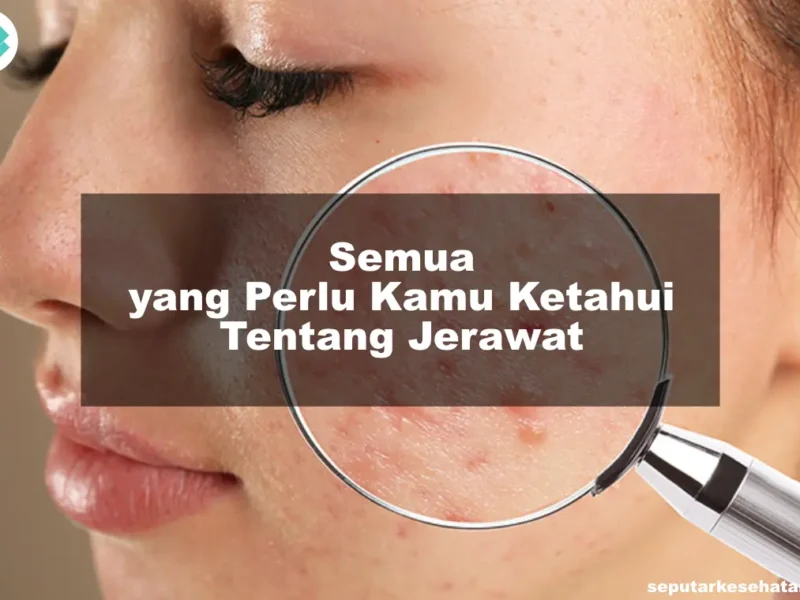 Semua yang Perlu Kamu Ketahui Tentang Jerawat