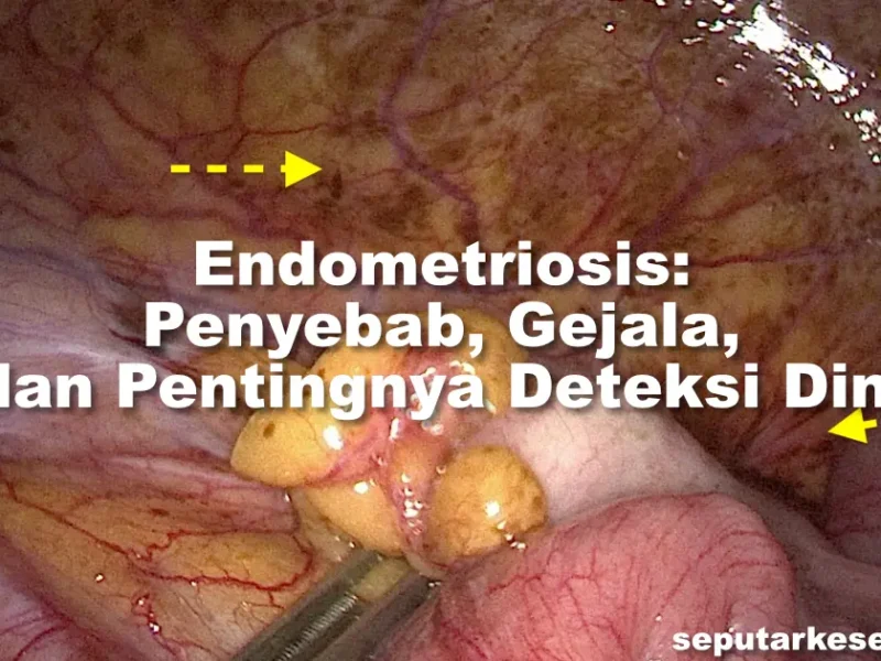 Endometriosis Penyebab, Gejala, dan Pentingnya Deteksi Dini