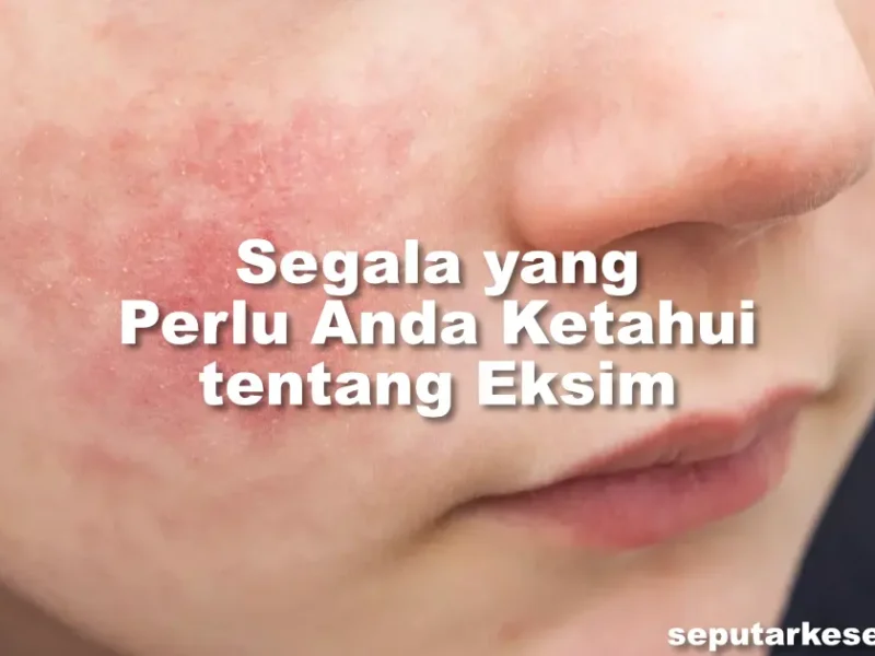 Segala yang Perlu Anda Ketahui tentang Eksim